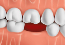 tooth-replacement-options